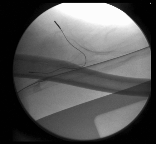 Figure 5. Fluoroscopic image used only to show final electrode position relative to the humeral shaft, at the level of the mid-humerus.