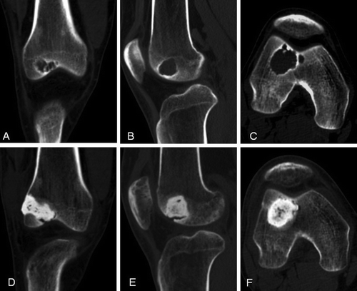 Figure 4. An accessory cavity over a sclerotic wall was successfully treated using the navigation system. Pre-operative CT images (A to C) showed that the accessory tumor cavity was located medial to the main cavity over the sclerotic wall. In post-operative CT images (D to F), not only the accessory cavity but also the main cavity were completely filled with bone cement. We could easily localize the accessory cavity in three dimensions using the specially designed burr equipped with a navigation probe (G).