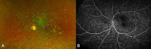 Figure 4 (A) Pseudo-color photo versus (B) fluorescein angiography of an eye with asteroid hyalosis and severe non-proliferative diabetic retinopathy.