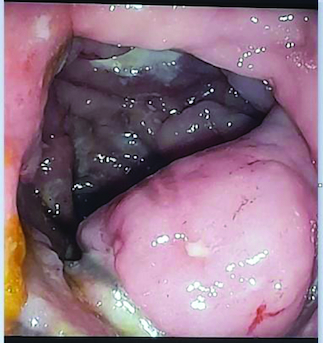 Figure 2. Polypoid mass lesion with ulceration.