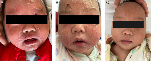 Figure 2 Skin manifestation evolution of a patient with Staphylococcal Scalded Skin Syndrome (SSSS). (A) A patient with SSSS on admission. Skin erythema, blistering, periocular crusting, radial fissuring, exfoliating rash, and positive Nikolsky’s sign were seen on the face. (B) After 3 days of treatment, the erythema subsided, and the blisters dried up and crusted. (C) The same patient after 7 days of treatment, all the erythema resolved, and a few desquamations were left with mild pigmentation and without scarring.