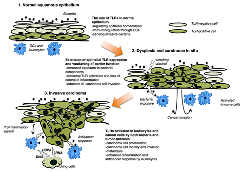 Figure 1. Effects of Toll-like receptors in the squamous epithelium. Bacteria do not penetrate the normal epithelium and contribute to epithelial homeostasis. In this setting, bacterial components are recognized by dendritic cells (DCs), which can limit inflammatory response. Conversely, invasive bacteria are sensed by Toll-like receptors (TLRs) expressed on both basal cells of the epithelium and inflammatory cells, hence inducing an inflammatory reaction. In the presence of known carcinogens such as tobacco and alcohol, the barrier function of epithelium is compromised and bacteria can penetrate. This is facilitated in the setting of carcinoma in situ, as the cellular and epithelial polarity are compromised and TLR expression extends to the whole epithelium. Such alterations allow for the activation of subepithelial cells, favoring invasiveness. In invasive carcinoma, bacterial components as well as endogenous TLR ligands released by dying cells activate both leukocytes and tumor cells. Carcinoma cells respond to TLR ligands by secreting pro-inflammatory cytokines, proliferating and exhibiting an invasive phenotype, whereas leukocytes do so by stimulating inflammation and killing malignant cells. DC, dendritic cell; HSP, heat-shock protein.
