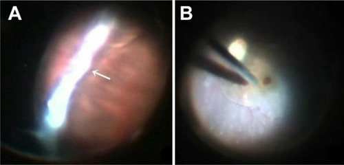 Figure 1 Intraoperative view of the extreme periphery showing severe snowbanking (arrow) (A) and of drainage of the subretinal fluid through the macular hole (B).