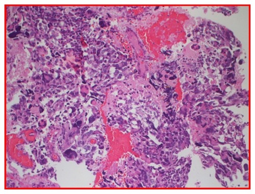 Figure 4 H and E glioblastoma multiforme, World Health Organization grade IV, with evidence of nuclear pleomorphism, mitotic activity, endothelial hyperplasia, and areas of palisading necrosis.