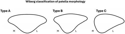 Figure 2 Wiberg classification of patellar morphology. Type A: the medial facet is almost equal to the lateral facet. Type B: the medial facet is smaller than the outer facet. Type C: the medial facet is much smaller than the lateral facet.