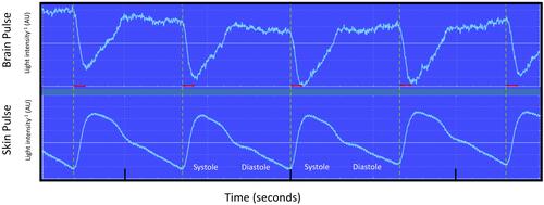 Figure 7 Simultaneous recording of brain and forehead skin PPG waveforms during a period of hypoxia (inspired oxygen 10%), for a single subject (volunteer 6). Dashed lines mark the start of each skin pulse. The brain oximeter PPG waveform developed an earlier and steeper rise during the systolic phase and the V and Y waves were less prominent, compared with the baseline PPG waveform (see Figure 1). These changes were not present in the simultaneous skin PPG waveform. These changes may reflect an increase in cerebral blood flow during hypoxia, resulting in a more rapid increase of blood volume in the brain microcirculation and therefore an earlier upstroke in the brain PPG waveform. Note the start of the brain PPG waveform is delayed by around 100 msec compared to the skin (red arrows).Abbreviation: AU, arbitrary units.