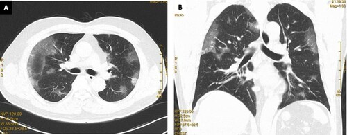 Figure 4. Typical changes of COVID-19 pneumonia on lung computed tomography showing bilateral multifocal patchy ground glass opacities: (A) transverse view; (B) coronal view.