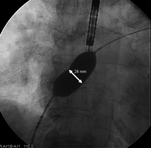 Figure 1 Stretched diameter of the atrial septal defect measured by sizing balloon.
