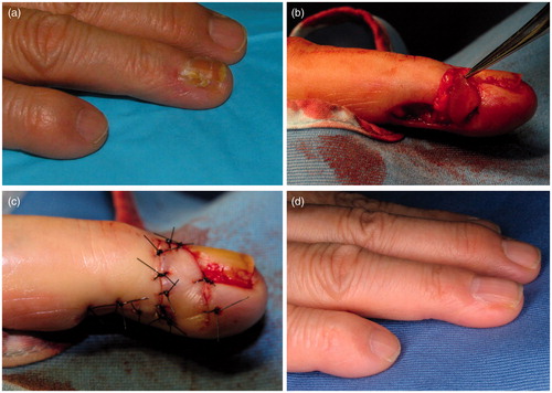 Figure 3. (a) Nail grooving deformity was observed in the right ring finger. (b) View of flap elevation. The flap was harvested with fat. (c) View of flap fixation. (d) Three years postoperatively, tumor recurrence was not observed.