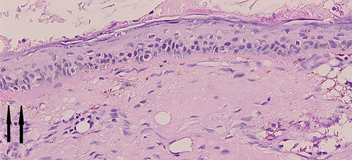 Figure 4 PAS-staining revealed thickening of the basement membrane pointed with black arrows.