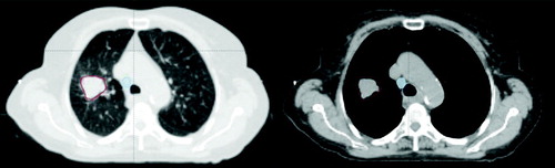 Figure 1.  This is an axial CT slice of patient no. 10. The GTV_t, in red, was contoured using the lung window setting and the GVT_l, in light blue, was contoured using the soft tissue window.