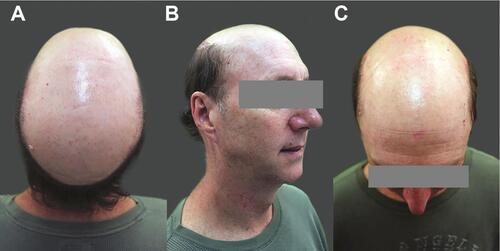 Figure 11 Case 1, a 63-year-old Caucasian male with Norwood (NW) 7 hair loss compounded by retrograde alopecia. (A) Bird’s eye view from the back; (B) right oblique view; and (C) bird’s eye view from the front.