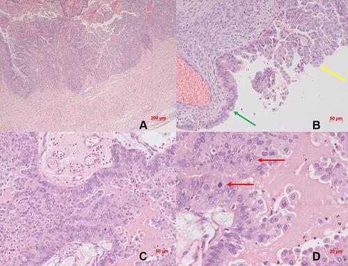Figure 4 Histological findings of the endometrioid borderline ovarian tumor (eBOT): (A) overview including the ovarian capsule; (B) transition from the endometriotic cyst wall (green arrow) to the proliferated part with borderline malignancy (yellow arrow); (C) section with proliferated part; (D) detailed view with mitotic figures (red arrows).