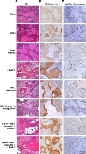 Figure 6 Histological overview of the explants.Notes: For a histological overview, explants were stained with HE (A). For detection of newly formed bone tissue, we performed immunohistological staining against collagen type I (B), the main component of the organic bone matrix, and alkaline phosphatase (C), an enzyme synthesized by osteoblasts. Areas positive for collagen type I and alkaline phosphatase were obvious in all explants to some extent. Collagen type I marks the newly formed bone (brown color) which was found mainly near the bone substitute. Alkaline phosphatase (brown color) could be detected near the ossification zone next to osteoblasts synthesizing new bone tissue.Abbreviations: MSC, mesenchymal stem cells; HE, hematoxylin-eosin; rhBMP-2, recombinant human bone morphogenetic protein 2.