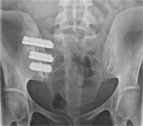 Figure 2 Postoperative radiograph demonstrating placement of three fusion implants across the sacroiliac joint.