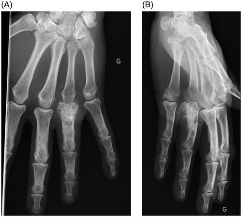 Figure 1. (A) Plain AP view of the hand, bone lysis and periosteal reaction are visible on the proximal phalanx of the fourth ray. G Left side (in French: Gauche). (B) Plain lateral view of the hand. G Left side (in French: Gauche)