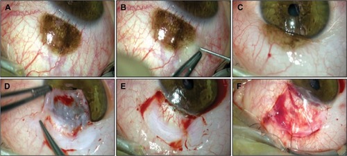 Figure 2 (A) Color photograph of the surgical video after the application of topical anesthesia (five drops of a single dose of 0.4% oxybuprocaine hydrochloride). (B and C) Subconjunctival anesthesia with 2% mepivacaine. (D) The conjunctival tumor was resected using a wide excisional biopsy with a tumor safety distance of 2.0 mm. The resection was performed using the “no-touch” technique. (E) The 12 mm × 10 mm conjunctival defect. (F) The AM was placed with the stromal side facing down toward the defect. The AM was secured to the surrounding conjunctiva by five interrupted 9-0 Vicryl sutures.
