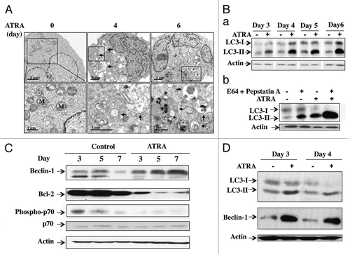 Figure 1 ATRA activates autophagic flux in APL cells NB4 cells (1 × 105 cells/ml) were treated with ATRA (1 µM) for the times indicated in the presence and absence of E64 (10 µg/ml) + methyl ester pepstatin (1 µg/ml). (A) Cells were examined by electron microscopy during the time course of ATRA-induced granulocytic differentiation. At time 0, the cells displayed rounded nuclei filled with euchromatin, and a ribosome-rich cytoplasm with well-defined mitochondria. After 4 and 6 d of ATRA treatment, the nuclei were poly-lobed and had a higher heterochromatin content. Most of the cell profiles also contained several prominent cytoplasmic vacuoles containing large amounts of membranous structures at different stages of degradation (arrows). (B) Autophagy and autophagic flux were also evaluated by immunoblot analysis of LC3-II levels in cell extracts, using β actin as a loading control. (C) Beclin 1 and Bcl-2 protein levels and mTOR activity were determined following immunoblot analysis using antibodies directed against Beclin 1, Bcl-2, phospho-p70S6 kinase, p70s6 kinase and β actin. (D) Immunoblot analysis of LC3-II and Beclin 1 proteins in HL60 cells incubated with ATRA for 3 or 4 d.