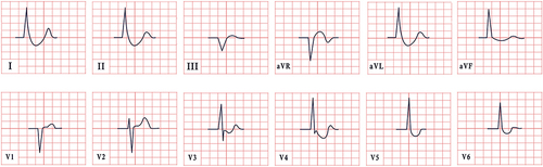 Figure 3 ECG features in digoxin intoxication, revealing absent P waves, normal cardiac axis, and a distinctive downsloping ST-segment depression in leads I, II, aVL, V4-V6.