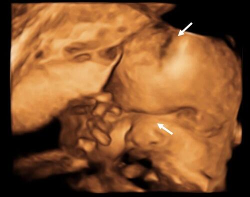 Figure 1 3D-ultrasound at 29 WGA. The foetus has frontal prominence and a cloverleaf skull suggestive of craniosynostosis and hypoplastic nasal bone (white arrows).