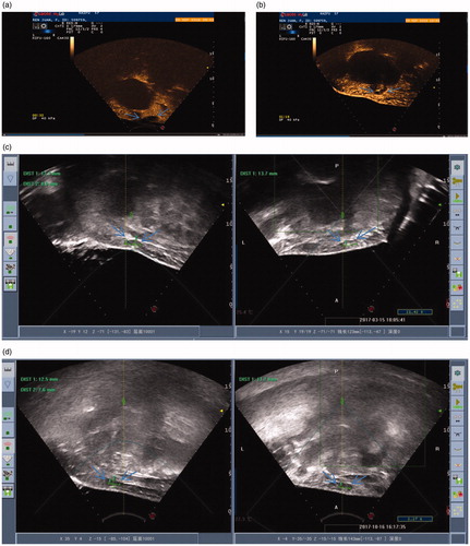 Figure 1. (a) CEUS image of an AWE cyst before the HIFU procedure. (b) CEUS image of an AWE cyst immediately after the HIFU procedure. (c) Ultrasonic image of an AWE cyst 6 months after the HIFU procedure. (d) Ultrasonic image of an AWE cyst 12 months after the HIFU procedure.