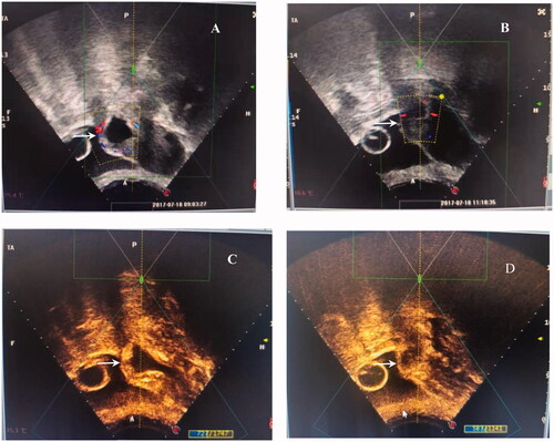 Figure 1. The signal of blood flow and contrast-enhanced ultrasound obtained from a patient with type III CSP treated with HIFU. A/C: abundant blood supply around the embedding area of the GS in the previous cesarean section scar (white arrow) before HIFU ablation; B/D: reduced blood supply around the embedding area of the GS in the previous cesarean section scar (white arrow) after HIFU ablation.