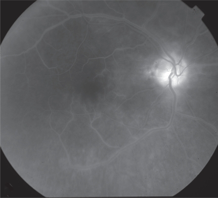 Figure 1 Fluorescein angiography OD showing leakage from the subretinal peripapillary lesions and the optic disc with vasculitis of the posterior pole.