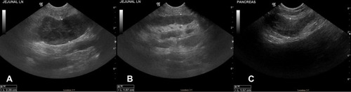 Figure 2 Ultrasound images of enlarged hypoechoic jejunal lymph nodes (A and B) and hypoechoic pancreas, suggesting pancreatitis (C).