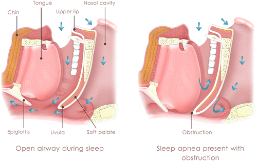 Figure 1B In the supine position, gravity takes the mandible down and back along with the tongue and soft palate.