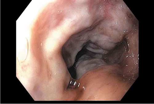 Figure 4. Esophageal varices status post band ligation on upper endoscopy