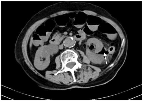 Figure 2 The computed tomography scans showing gas density in the ablation areas (arrow).