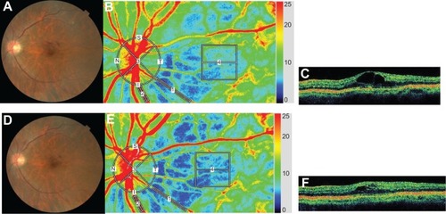 Figure 7 Representative eye with branch retinal vein occlusion-associated macular edema.