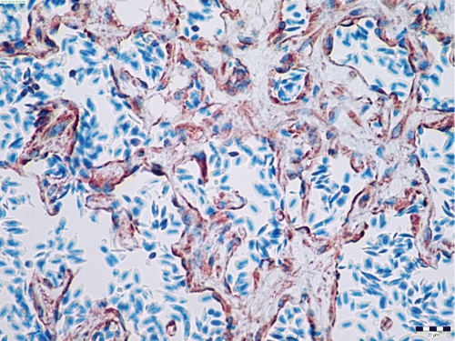 Figure 5. Sarcomeric actin moderate cytoplasmic positivity (brown) in benign neoplastic smooth muscle cells of the angiolipoleiomyoma. Immunohistochemistry, diamino-benzidine–chromogen. Bar: 20 µm.