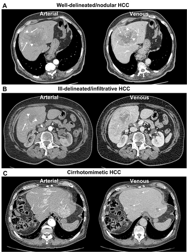 Figure 1 Contrast-enhanced axial CT images of the liver in (A–C) display arterial and venous sequences of patients with different growth patterns and imaging biomarkers of hepatocellular carcinoma (HCC): non-rim arterial phase enhancement (arrow), washout with tumor-liver difference (dotted arrow), internal tumor arteries (arrowheads), tumor capsule (*), hypodense halo (†), peri-tumoral enhancement (‡), and index tumor (dotted circle).