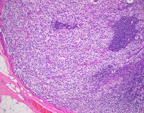 Figure 3 Microphotograph demonstrating an anaplastic ependymoma within a cervical lymph node. (Hematoxylin and Eosin, X200).