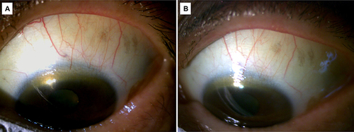 Figure 3 Slit lamp examination at (A) three months and (B) two years after treatment commencement showed significant reduction of the inflammation over the superior bulbar conjunctiva.