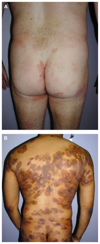 Figure 1 Patients with mycosis fungoides presenting with limited (A) patches/plaques typically involving the buttocks, and with disseminated (B) patches/plaques and tumors.