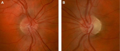 Figure 2 Right optic nerve (A) of a patient with acute LHON-related vision loss showing mild hyperemia, blurring of the disc margin, and elevation of the optic nerve head from swelling of the peripapillary retinal nerve fiber layer. LHON-related vision loss in the left eye had occurred 6 months prior leading to prominent temporal optic nerve pallor (B) from atrophy of the retinal nerve fiber layer.