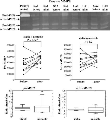 Figure 3a.  A representative zymography gel shows the pro-MMP9 and activated MMP9 in tissue extracts from human saphenous veins sampled at the start of and end of surgical preparation for CABG from two patients with stable (SA) and one patient with unstable angina (UA). proMMP9 as well as active MMP9 are illustrated by dot-plots, showing the individual change from the first to the second biopsy for patients with stable (n = 5) and unstable (n = 7) angina pectoris. The ratio between the second and first value is shown as a box-plot for each group. Pro-MMP9, but not active MMP9, was increased in all patients after surgical handling. For proMMP9 the log-scale-estimated population factor of increase (ratio After/Before) was 1.4, with a 95% confidence interval of (1.0, 1.9). For active MMP9 the corresponding estimate was 1.2, with confidence interval (1.0, 1.4). Note that the scale of pro- and active MMP9 on the dot-plots are different.