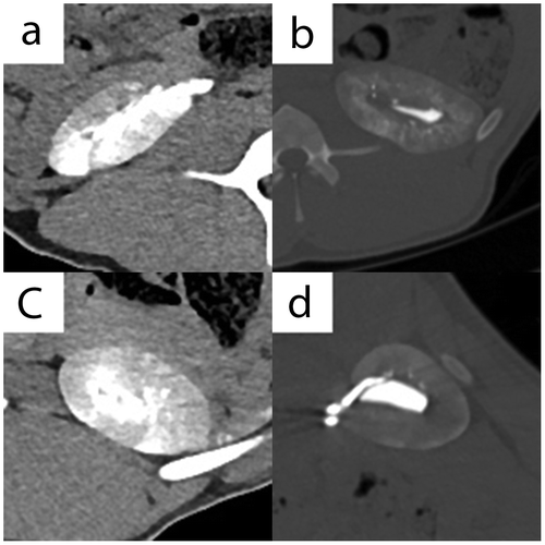 Figure 3. CT imaging features. (a) Axial plane, I3–30f kernel, without intravenous contrast material, right kidney - I-Pure ETHIBLOC_Reloaded; (b) Axial plane, I3–70f kernel, without intravenous contrast material, left kidney—II-ETHIBLOC_Reloaded/iodized oil mixture (1:1); (c) Axial plane, I3–30f kernel, without intravenous contrast material, left kidney—III-ETHIBLOC_Reloaded/ethanol-60% mixture (8:2); (d) Axial plane, I3–70f kernel, without intravenous contrast material, right kidney—IV-Histoacryl/iodized oil mixture (1:3).