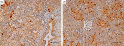 Figure 6. Turkey, pancreas, avian influenza A virus expression. Presence of the viral nucleoprotein was detected within the nuclei and the cytoplasm of both necrotic and intact exocrine pancreatic cells and also of some ductal cells (a). Islet cells, when detectable, appeared negative (b). (A case no. 11, B case no. 8. AIV IHC, DAB chromogen, Haematoxylin counterstain) bar = 50 µm.