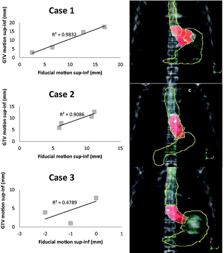 Figure 3. Linear regression of the relation between the gross tumor volume (GTV) and fiducial superior-inferior (sup-inf) displacements for the patient with the highest R2 (Case 1); approximate median R2 (Case 2); the lowest R2 (Case 3). Representative AP digitally reconstructed radiographs (DRRs) showing the placement of fiducial markers (white) with respect to the GTV (central shaded structure), stomach (inferior outlined structure), and esophagus (superior outlined structure) in three representative patients with gastroesophageal junction (GEJ) tumors. Case 1 (a) had excellent GTV-fiducial correlation (R2=0.98), Case 2 (b) had good GTV-fiducial correlation (R2=0.91), and Case 3 (c) had poor GTV-fiducial correlation (R2=0.48). Case 1 is a Siewert’s type 2 GEJ tumor and extends into the gastric cardia where there is the greatest motion; the fiducials are also in the cardia. Case 2 is a Siewert’s type 1 GEJ tumor with the GTV primarily in the distal esophagus approaching the GEJ, the fiducials are also in the distal esophagus. Case 3 is a Siewert’s type 2 GEJ tumor with the GTV extending into the gastric cardia, but the fiducial is higher in the distal esophagus where there is less motion.