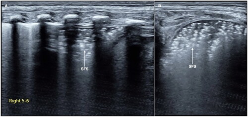 Figure 5. Grade II RDS. RDS patients. LUS showed the SFS-like lung consolidation only involved partial intercostal space (the right 6th region of this patient) of the right lung (A: perpendicular scanning; B: parallel scanning).