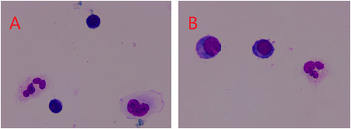 Figure 2 Microscopic examination of cerebrospinal fluid (CSF) cells: The microscopic examination of the cerebrospinal fluid as shown in (A and B) Reveals a mixed-cell reaction type predominantly composed of lymphocytes.