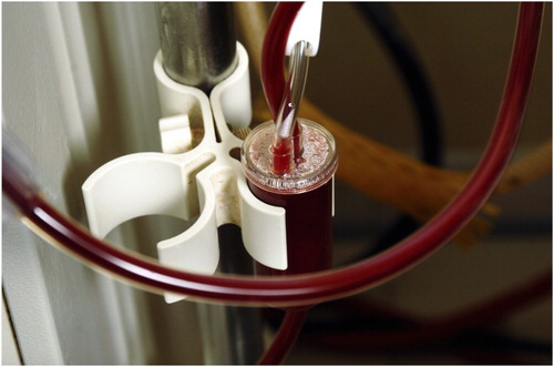 Figure 4. Blood Filtered Cannula for Dialysis. (Universal Group / Getty Images)