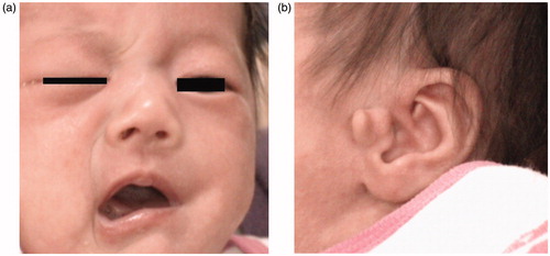 Figure 1. (a) Left facial paralysis becomes evident when the patient cries. She is not able to close the left eyelid and shows complete unilateral facial palsy on the left side. (House–Brackmann Grade V and Sunnybrook Grading Score 9). (b) There is a small anomaly of pretragal duplication on her left ear.
