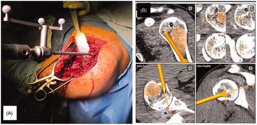 Figure 4. (A) Navigated osteotomies are used to perform resection; (B) the margin can be continuously controlled on the screen. In the little squares, the navigation shows that there is 5 mm 10 mm, and 15 mm beneath the osteotomy, respectively.