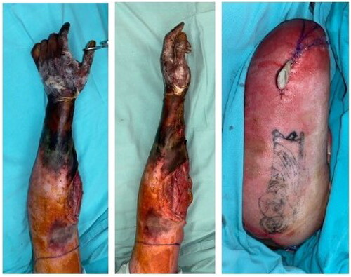 Figure 2. Left upper limb dry gangrene, as depicted in the first two pictures, with the last picture showing the limb after amputation.