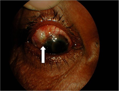 Figure 1 Leaking bleb with Siedel test positive (arrow) in Case 1.