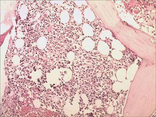 Figure 1 Low power BM core biopsy (×20) demonstrating hypercellularity consistent with a myeloproliferative disorder, and revealed 70% cellularity with 10% κ light chain restricted plasma cells.